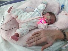 Image result for Most Premature Baby Born