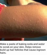 Image result for How to Get Rid of Welts