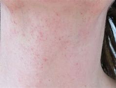 Image result for Petechiae Mouth