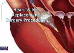 Image result for Heart Valve Replacement Surgery Recovery