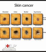 Image result for Skin Cancer Identification Chart