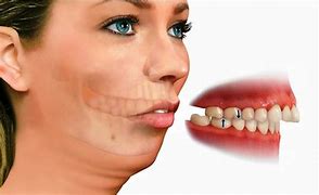 Image result for Protruding Jaw Images