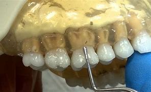 Image result for Teeth. File Betwen