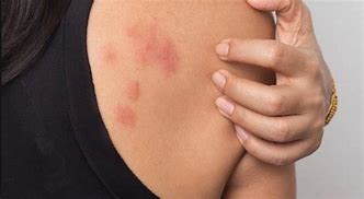 Image result for Allergic Bed Bug Bites
