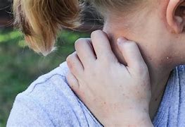 Image result for Scabies Eczema