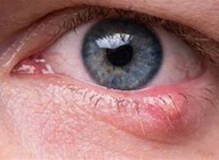 Image result for Cyst On Eyelid