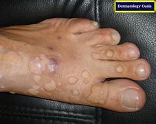 Image result for Verruca Vulgaris Common Warts