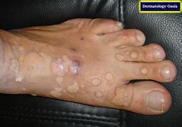 Image result for Verruca Lesion