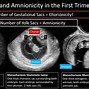 Image result for Twin Types Ultrasound