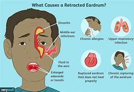 Image result for Earache Adult