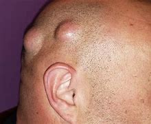 Image result for Sebaceous Cyst Removal