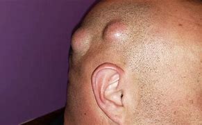 Image result for Cyst On Head Scalp