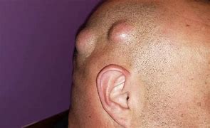 Image result for Sebaceous Cyst Scalp