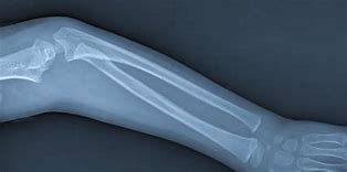 Image result for X-ray of Broken Arm