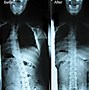 Image result for Chiropractor Back Before and After