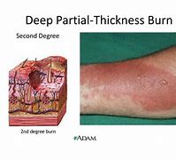Image result for 2nd Degree Partial Thickness Burn