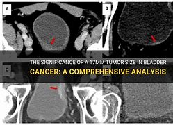 Image result for Bladder Tumor