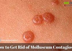 Image result for Molluscum Contagiosum in Tagalog