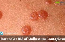 Image result for Molluscum STD Treatment