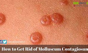 Image result for How to Get Rid of Molluscum Contagiosum