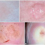 Image result for Genital Wart Identification