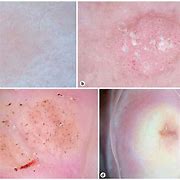 Image result for Genital Warts Dermnet