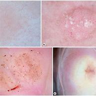 Image result for Tretinoin Penile Genital Warts