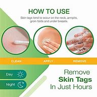 Image result for Skin Tag Removers That Work