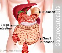 Image result for gastroenteritis