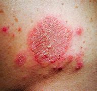 Image result for Food Allergy Eczema