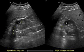 Image result for Simple Renal Cyst Ultrasound