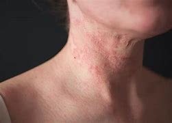 Image result for Eczema Scabs