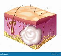 Image result for Sebaceous Cyst Diagram