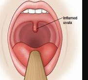 Image result for Inflamed Uvula