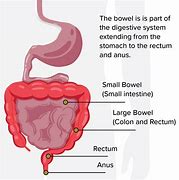 Image result for Bowel Cancer Diagram