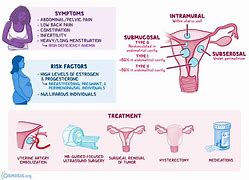 Image result for Uterine Fibroid Enlarged Uterus