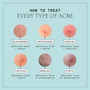 Image result for Skin Acne Types