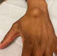 Image result for Benign Tumor in Wrist