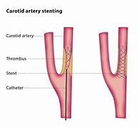 Image result for Stenting Carotid Artery in Elderly