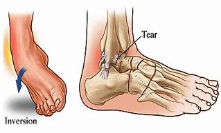 Image result for Types of Ankle Sprains