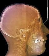 Image result for Cancer in the Jaw Area