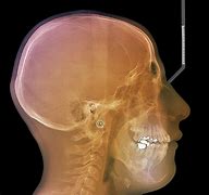 Image result for Jaw Bone Cancer