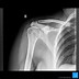 Image result for 2 View Chest X-Ray