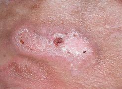 Image result for Skin Ulcer Erosia