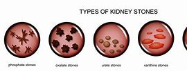 Image result for Four Types of Kidney Stones