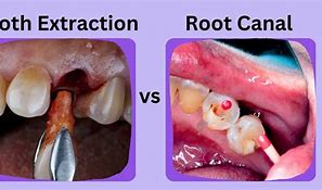 Image result for Root Canal Extraction