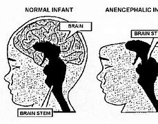 Image result for Anencephaly Diagram