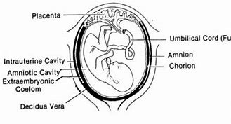 Image result for Anencephaly Fetal Ultrasound