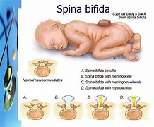 Image result for Meningomyelocele vs Meningocele