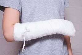 Image result for Badly Broken Arm